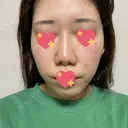 ヴェルヴェットスキン 表参道スキンクリニック 名古屋院（DAILY SKIN CLINIC提携院） AFTER サムネイル用