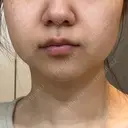 脂肪溶解注射（顔） 湘南美容クリニック 宇都宮院 DAY 24 サムネイル用