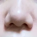 小鼻縮小（切開） ながしまクリニック AFTER サムネイル用