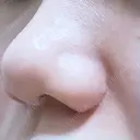 小鼻縮小（切開） ながしまクリニック DAY 293 サムネイル用