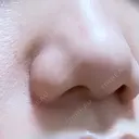 小鼻縮小（切開） ながしまクリニック DAY 293 サムネイル用