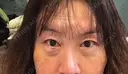 下まぶたの脂肪取り / ボトックス（目尻） TCB東京中央美容外科 町田院 DAY 4 サムネイル用