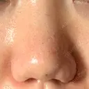 小鼻縮小（切開） / 鼻翼挙上 / 鼻孔縁挙上 くさのたろうクリニック AFTER サムネイル用