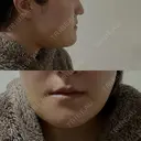 骨切り（あご） / 脂肪吸引（顔） / その他（輪郭） 銀座マイアミ美容外科 DAY 7 サムネイル用