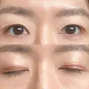 二重切開 城本クリニック 長崎院 DAY 136 サムネイル用