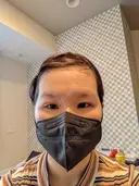 二重埋没 / 上まぶたの脂肪取り 東京イセアクリニック DAY 2 サムネイル用
