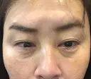 下まぶたの脂肪取り / ボトックス（目尻） TCB東京中央美容外科 町田院 DAY 7 サムネイル用