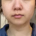 脂肪溶解注射（顔） 湘南美容クリニック 宇都宮院 AFTER サムネイル用