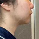脂肪溶解注射（顔） 湘南美容クリニック 宇都宮院 DAY 30 サムネイル用