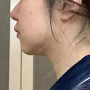 脂肪溶解注射（顔） 湘南美容クリニック 宇都宮院 DAY 30 サムネイル用