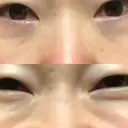 再生医療 / レーザートーニング（美白・肝斑） 品川スキンクリニック立川院 DAY 3 サムネイル用