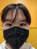 二重埋没 / 上まぶたの脂肪取り 東京イセアクリニック DAY 3 サムネイル用
