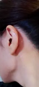 軟骨移植 LIKI CLINIC KOBE DAY 7 サムネイル用