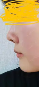 軟骨移植 LIKI CLINIC KOBE DAY 7 サムネイル用