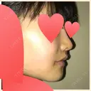 セットバック 大塚美容形成外科・歯科 大塚本院 DAY 40 サムネイル用