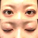 二重埋没 心斎橋中央クリニック DAY 0 サムネイル用