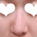 鼻尖形成（切開） / 鼻中隔延長（切開） / 小鼻縮小（切開） / 軟骨移植 / 骨切幅寄せ リラ・クラニオフェイシャル・クリニック DAY 306 サムネイル用