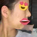 隆鼻術 / 鼻尖形成（切開） / 脂肪吸引（顔） / 軟骨移植 あいちビューティークリニック栄本院 DAY 5 サムネイル用