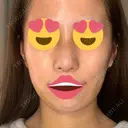 隆鼻術 / 鼻尖形成（切開） / 脂肪吸引（顔） / 軟骨移植 あいちビューティークリニック栄本院 DAY 6 サムネイル用