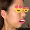 隆鼻術 / 鼻尖形成（切開） / 脂肪吸引（顔） / 軟骨移植 あいちビューティークリニック栄本院 DAY 6 サムネイル用