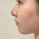隆鼻術 / 鼻尖形成（切開） / 小鼻縮小（切開） / 軟骨移植 フェアクリニック川口 DAY 9 サムネイル用