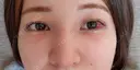 鼻尖形成（切開） / 鼻中隔延長（切開） / クマ治療 / 軟骨移植 R Beauty CLINIC 銀座院 DAY 16 サムネイル用
