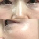 再生医療 / レーザートーニング（美白・肝斑） 品川スキンクリニック立川院 DAY 5 サムネイル用