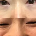 再生医療 / レーザートーニング（美白・肝斑） 品川スキンクリニック立川院 DAY 6 サムネイル用
