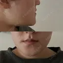 骨切り（あご） / 脂肪吸引（顔） / その他（輪郭） 銀座マイアミ美容外科 DAY 14 サムネイル用