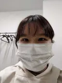 二重埋没 / 上まぶたの脂肪取り 東京イセアクリニック DAY 6 サムネイル用