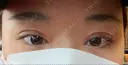 二重切開 / 目頭切開 / 眼瞼下垂（切開） 目白ポセンシアクリニック DAY 11 サムネイル用