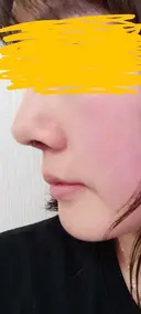 軟骨移植 LIKI CLINIC KOBE DAY 10 サムネイル用