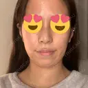 隆鼻術 / 鼻尖形成（切開） / 脂肪吸引（顔） / 軟骨移植 あいちビューティークリニック栄本院 DAY 9 サムネイル用