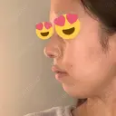 隆鼻術 / 鼻尖形成（切開） / 脂肪吸引（顔） / 軟骨移植 あいちビューティークリニック栄本院 DAY 9 サムネイル用