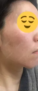 ヴァンパイアフェイシャル 大阪TAクリニック DAY 4 サムネイル用