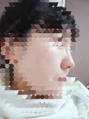 鼻尖形成（切開） / 鼻尖縮小 / ヒアルロン酸注入（鼻） 東京形成美容外科 船橋院 DAY 38 サムネイル用