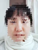 鼻尖形成（切開） / 鼻尖縮小 / ヒアルロン酸注入（鼻） 東京形成美容外科 船橋院 DAY 38 サムネイル用