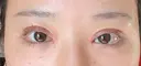 二重切開 / 目頭切開 / 眼瞼下垂（切開） 目白ポセンシアクリニック DAY 12 サムネイル用