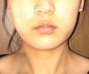 脂肪溶解注射（顔） 有楽町美容外科クリニック DAY 183 サムネイル用