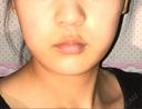 脂肪溶解注射（顔） 有楽町美容外科クリニック AFTER サムネイル用