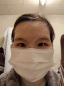 二重埋没 / 上まぶたの脂肪取り 東京イセアクリニック DAY 8 サムネイル用