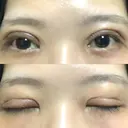 二重切開 / その他（目元） LIKI CLINIC KOBE DAY 7 サムネイル用