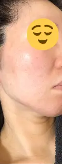 ヴァンパイアフェイシャル 大阪TAクリニック AFTER サムネイル用