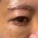 糸リフト / 脂肪吸引（顔） / 下まぶたたるみ取り / 眉下切開 / 脂肪注入（額） / 脂肪注入（輪郭） e:Top clinic（イートップクリニック） DAY 7 サムネイル用