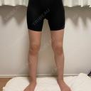 脂肪吸引（脚） オアシス美容外科 DAY 55 サムネイル用