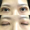 二重切開 / その他（目元） LIKI CLINIC KOBE DAY 10 サムネイル用