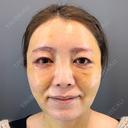 糸リフト / 脂肪吸引（顔） / 下まぶたたるみ取り / 眉下切開 / 脂肪注入（額） / 脂肪注入（輪郭） e:Top clinic（イートップクリニック） DAY 8 サムネイル用