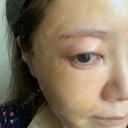 糸リフト / 脂肪吸引（顔） / 下まぶたたるみ取り / 眉下切開 / 脂肪注入（額） / 脂肪注入（輪郭） e:Top clinic（イートップクリニック） DAY 10 サムネイル用