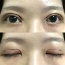 二重切開 / その他（目元） LIKI CLINIC KOBE DAY 12 サムネイル用