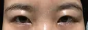 二重切開 / 眼瞼下垂（切開） ブリスクリニック形成外科・美容外科・美容皮膚科 福岡 AFTER サムネイル用